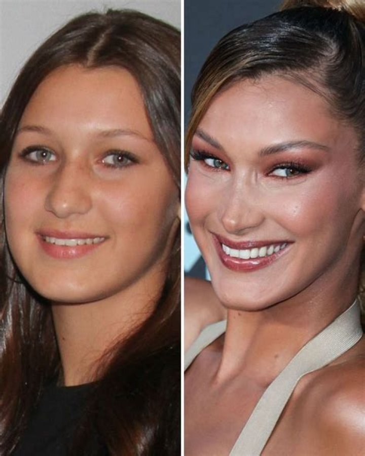 
Bella Hadid Before And After: Her Cosmetic Procedures Broken Down 