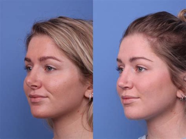 
Charli D’amelio Nose surgery before and after photos 