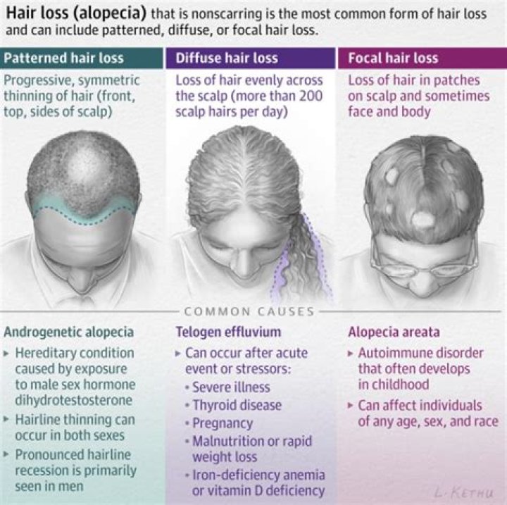Davy Klaassen Have No Hair Looks- Does He Have Alopecia Or Albinism?